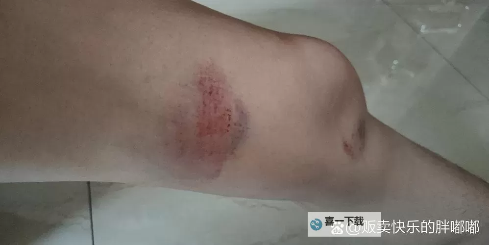 紫黑蘑菇横冲直撞引发红肿细节揭秘jH视频图1